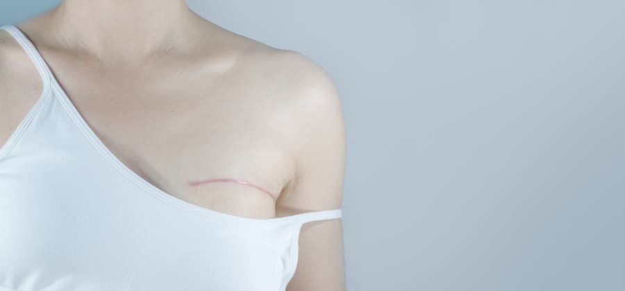 Patient displaying mastectomy scar
