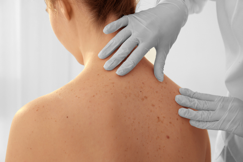 Physician examining back of person with many moles