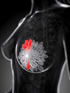 Black and white diagram of breast cells with presence of cancer highlighted in red