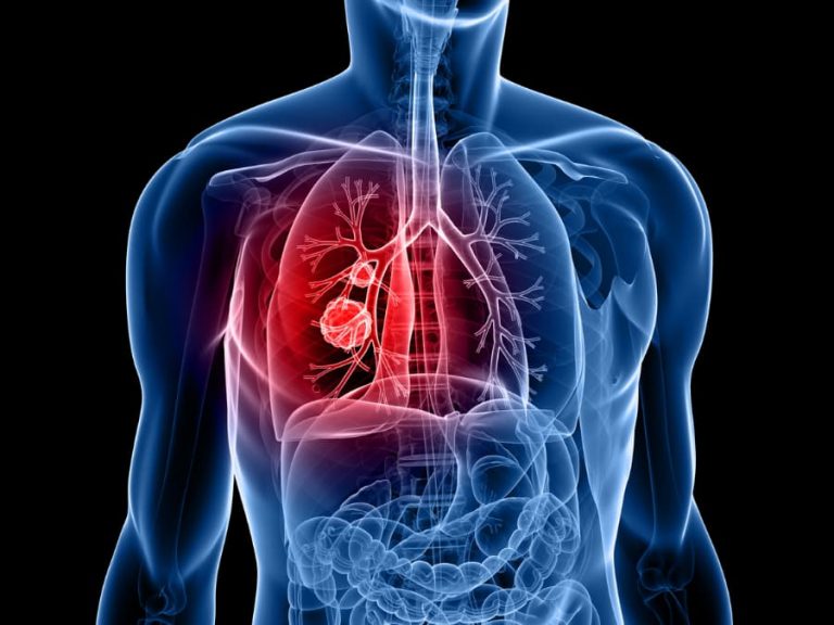 Diagram depicting lung cancer tumor