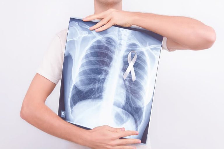 A man holds a lung x-ray image