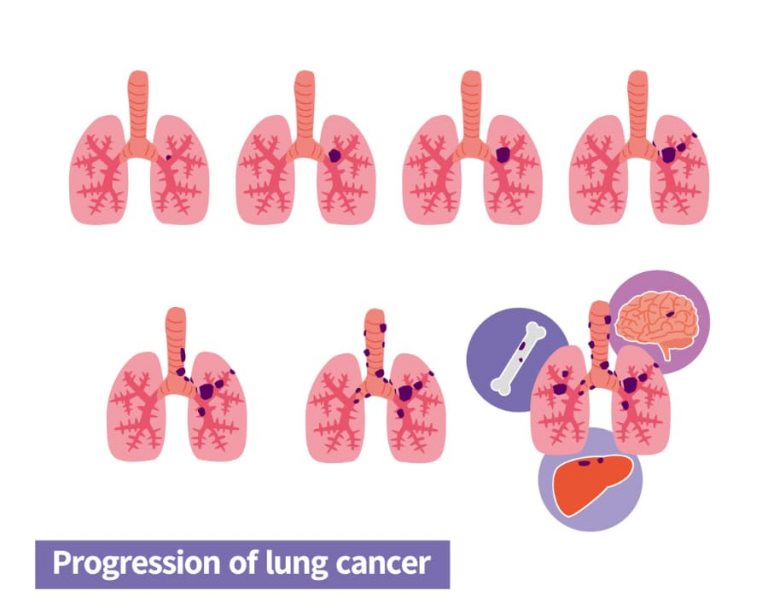Diagram depicting lung cancer stages
