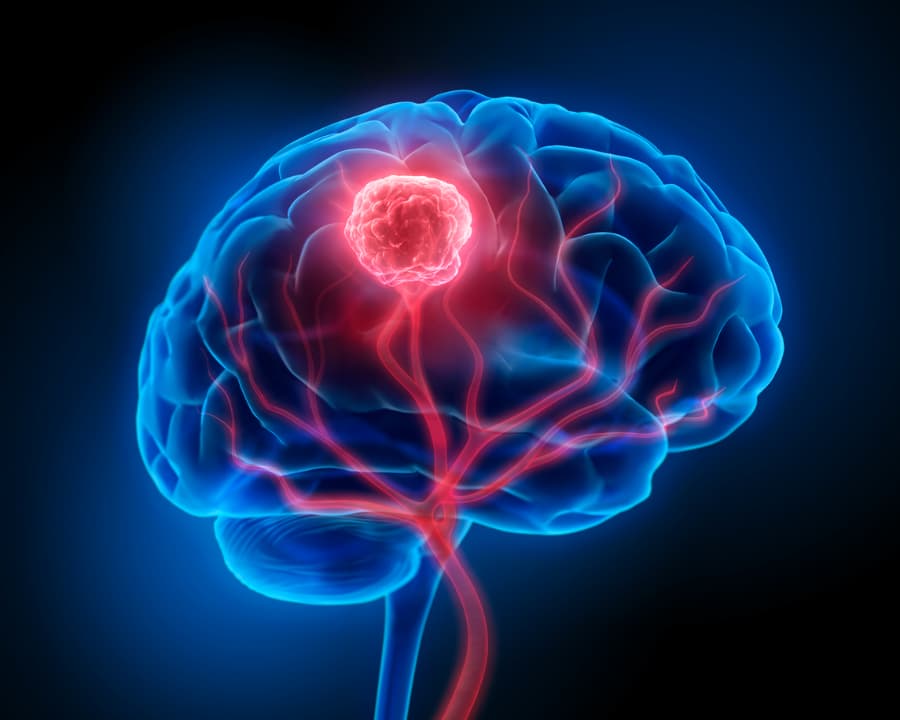 brain tumour consultation mumbai