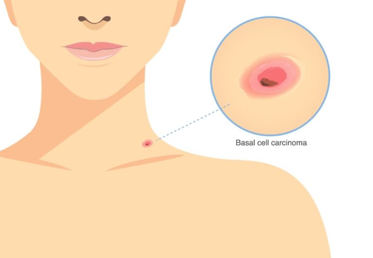 Illustration of Basal cell carcinoma on the woman's neck with closeup