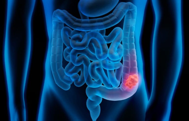 3D medical illustration of colorectal cancer and polyps