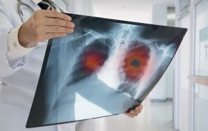 Doctor holding up X-ray scan of lungs with highlighted portions to show cancer
