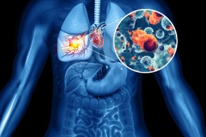 Medical Illustration showing lung cancer on CT scan