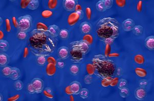 Chronic lymphocytic leukemia illustration