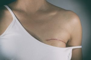 Patient wearing tank top that shows mastectomy scar