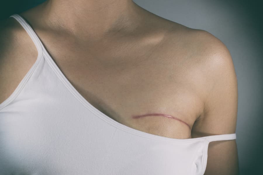Patient wearing tank top that shows mastectomy scar