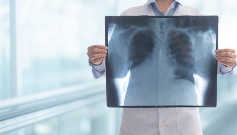 Radiologist holding up X-ray image of lungs