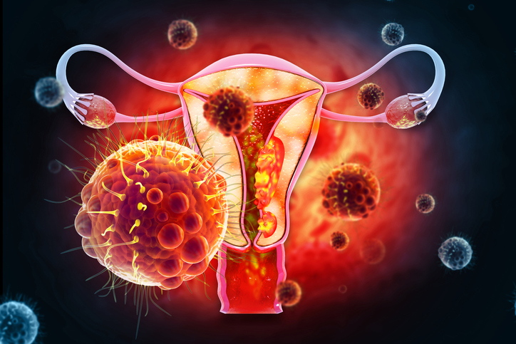 Illustration of cervical cancer