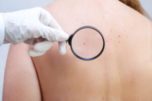 Doctor examines growth on patient’s skin