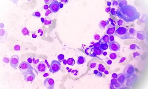 Diagram of bone marrow suggesting multiple myeloma