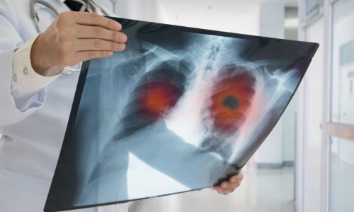 Doctor holding up X-ray scan of lungs with highlighted portions to show cancer