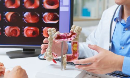 doctor-using-medical-model-to-explain-colon-biopsy-in-front-of-colonoscopy-images Doctor using medical model to explain colon biopsy in front of colonoscopy images