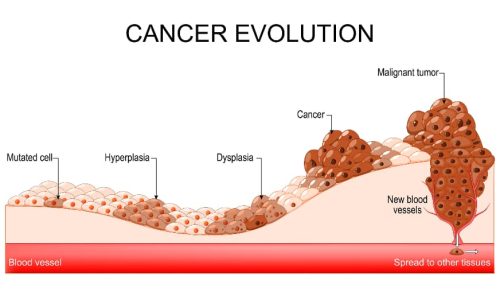 Medical concept image of cancer development and spread