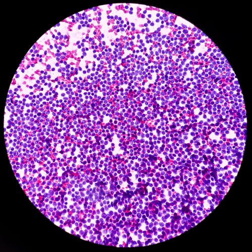 Micrograph image of lymph node affected by Hodgkin lymphoma