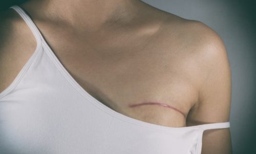 patient-wearing-tank-top-that-shows-mastectomy-scar Patient wearing tank top that shows mastectomy scar