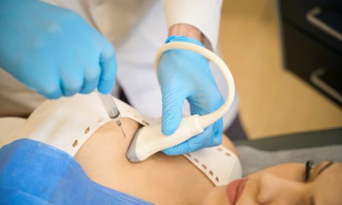 Physician performing ultrasound guided core needle biopsy